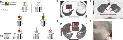 A Novel FLCN Intragenic Deletion Identified by NGS in a BHDS Family and Literature Review